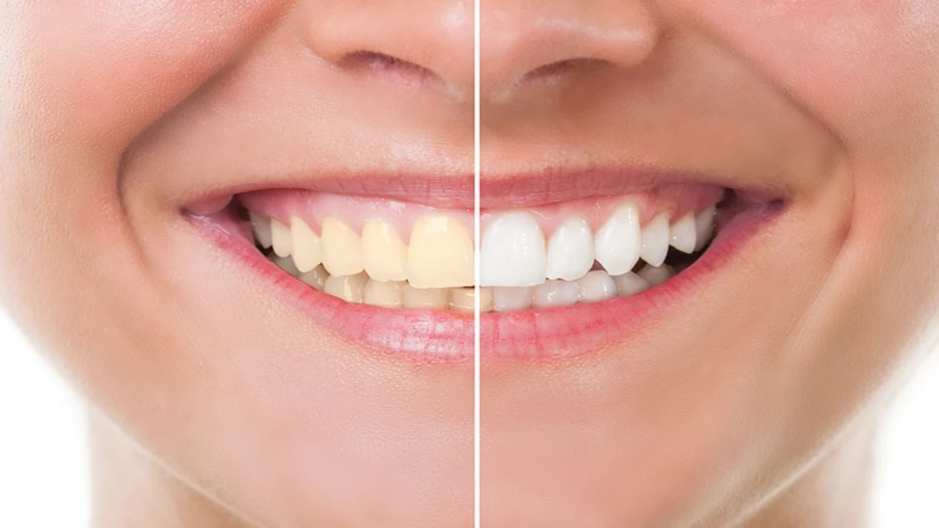 professional teeth whitening Chicago IL